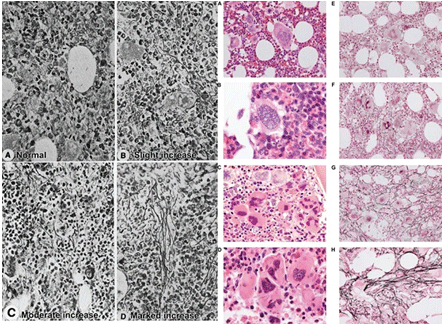 Grading of reticulin fibrosis