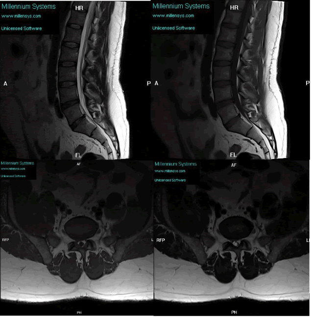 T1 And T2 Sagittal And Axial Images