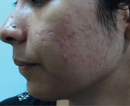 Chemical Peels For Post Acne Hyperpigmentation In Skin Of - 