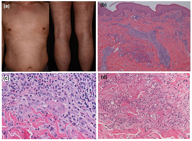 Erythema