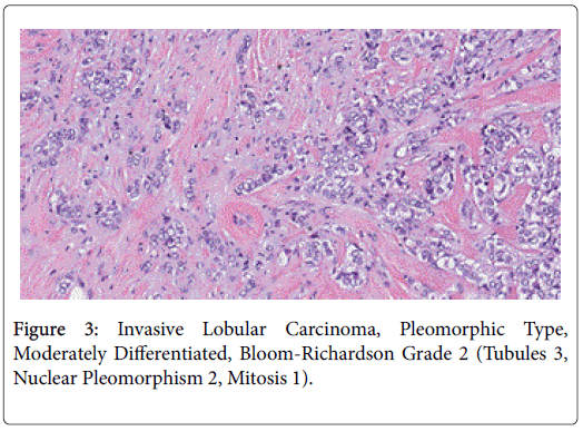 Breast-Cancer-Lobular-Carcinoma