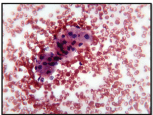 Fine Needle Aspiration Cytology in Warthin's Tumor: A Diagnostic tool ...