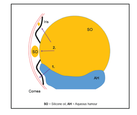 glaucoma