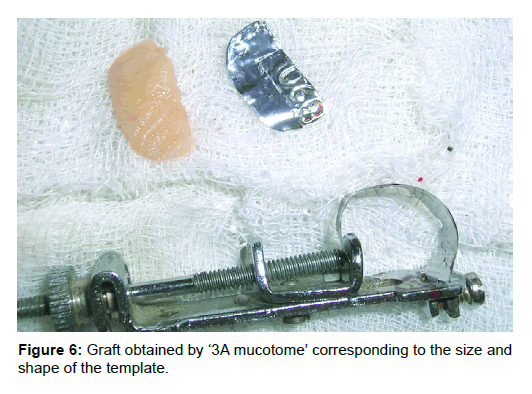 Medicine-Dental-Graft-obtained