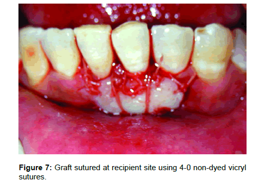 Medicine-Dental-Graft-sutured