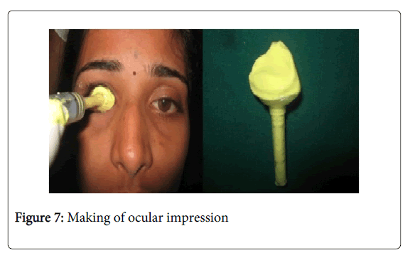 Medicine-Dental-Science-Making-ocular-impression