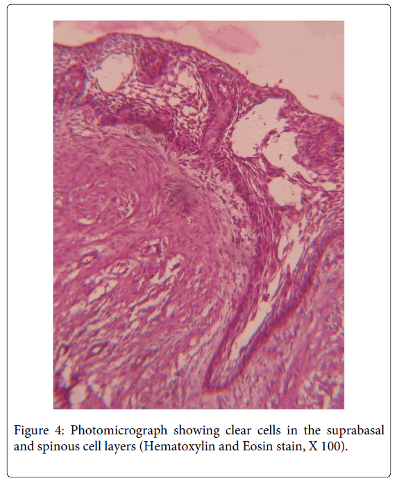 Medicine-Dental-Science-Photomicrograph-showing-clear-cells-suprabasal