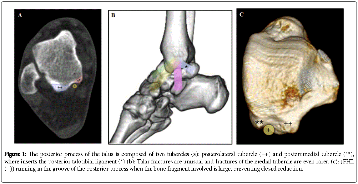 talus fracture treatment