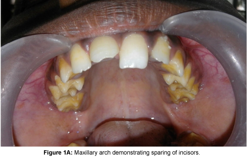 Pediatric-Dental-Care-Maxillary-arch