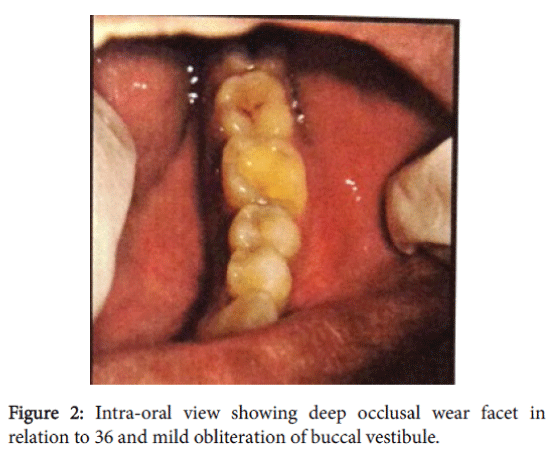 advances-cancer-prevention-deep-occlusal