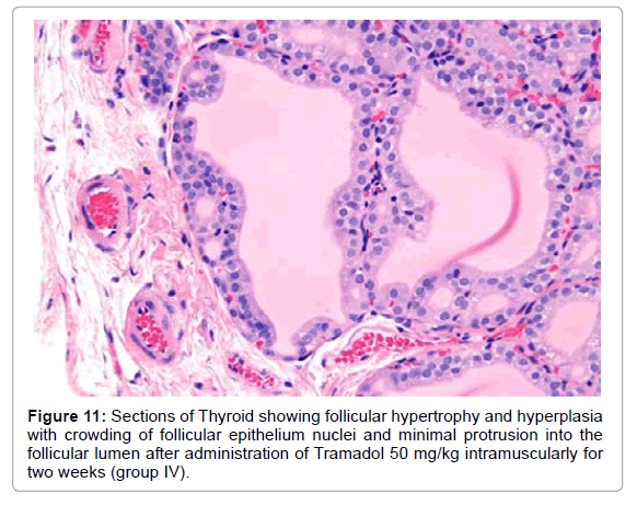 and disease tramadol thyroid