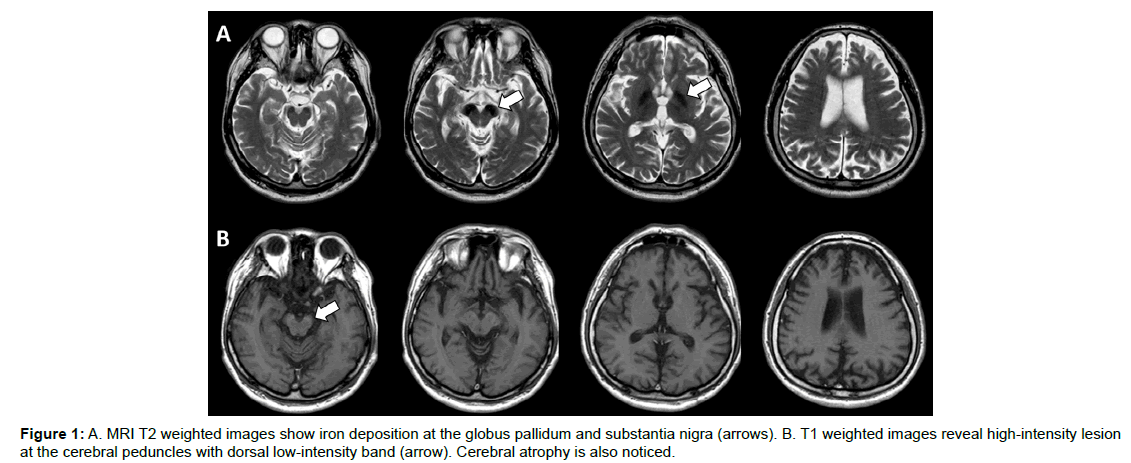 alzheimers-disease-parkinsonism-Cerebral-atrophy