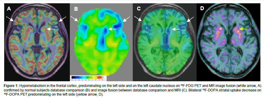 alzheimers-disease-parkinsonism-database-comparison