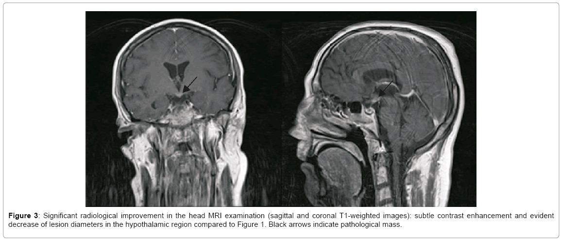 alzheimers-disease-parkinsonism-head-MRI