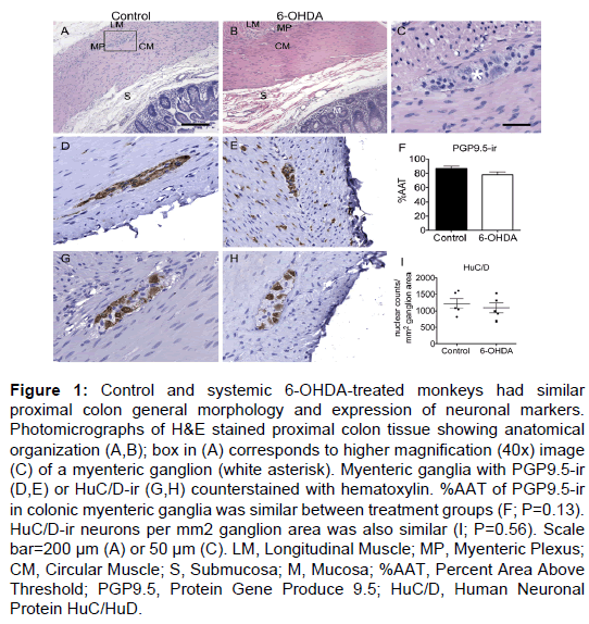 alzheimers-disease-parkinsonism-higher-magnification