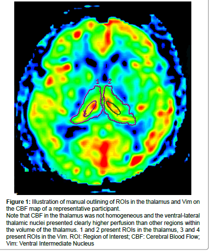 alzheimers-disease-parkinsonism-homogeneous-ventral