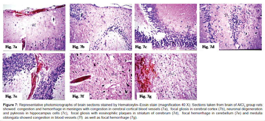 alzheimers-disease-parkinsonism-photomicrographs-brain
