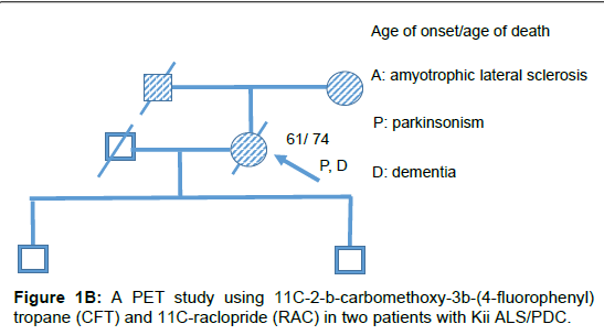 alzheimers-disease-parkinsonism-raclopride-RAC