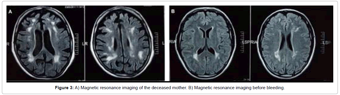 alzheimers-disease-parkinsonism-resonance-imaging