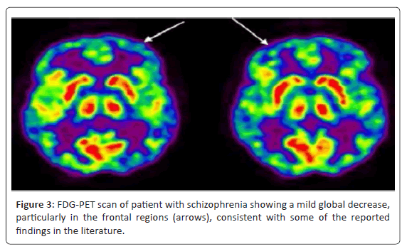 alzheimers-disease-parkinsonism-schizophrenia-showing