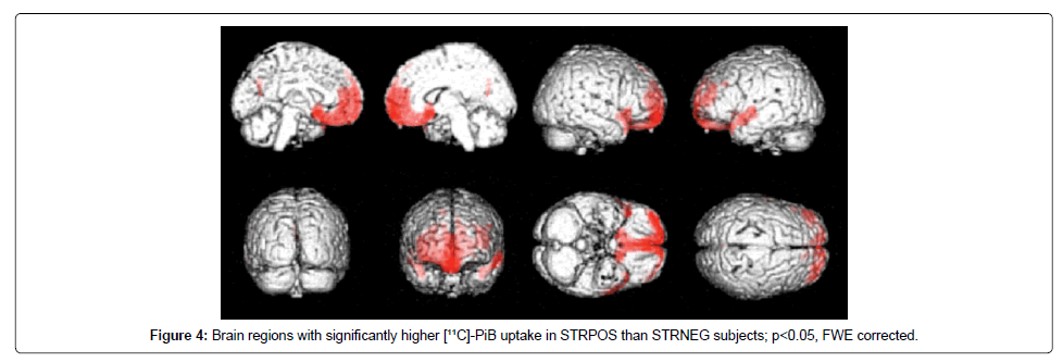 alzheimers-disease-parkinsonism-significantly-higher