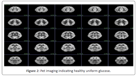 alzheimers-disease-parkinsonism-uniform-glucose
