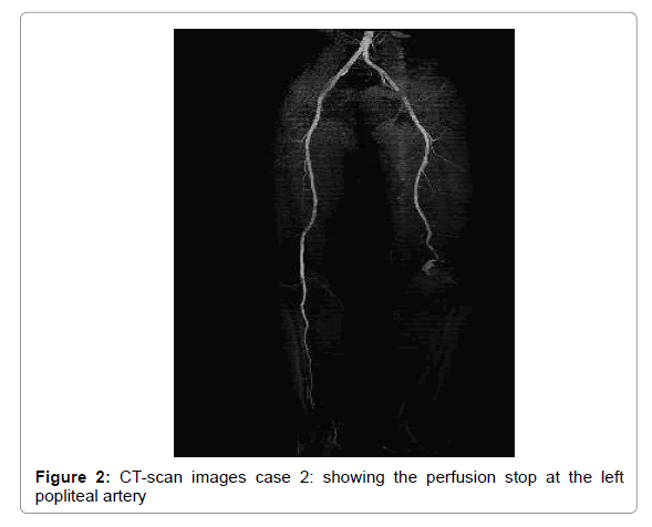 Vascular Injury in Obese Patients after Ultra-Low-Velocity ...