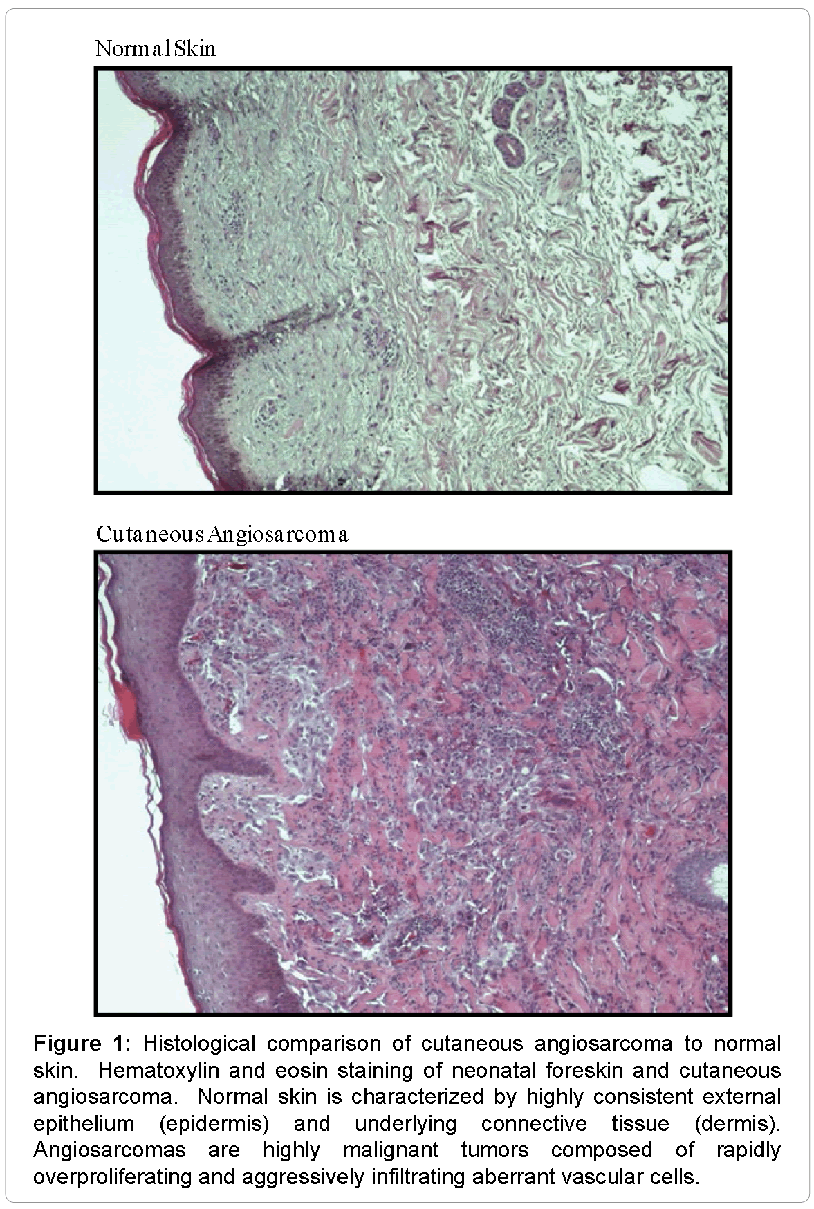 Angiology-blood-histological-comparison-cutaneous-angiosarcoma-normal