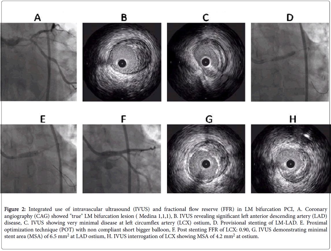 Angiology-intravascular-ultrasound