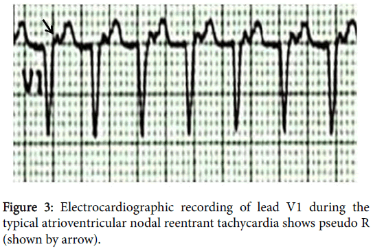 arrhythmia-Electrocardiographic-recording