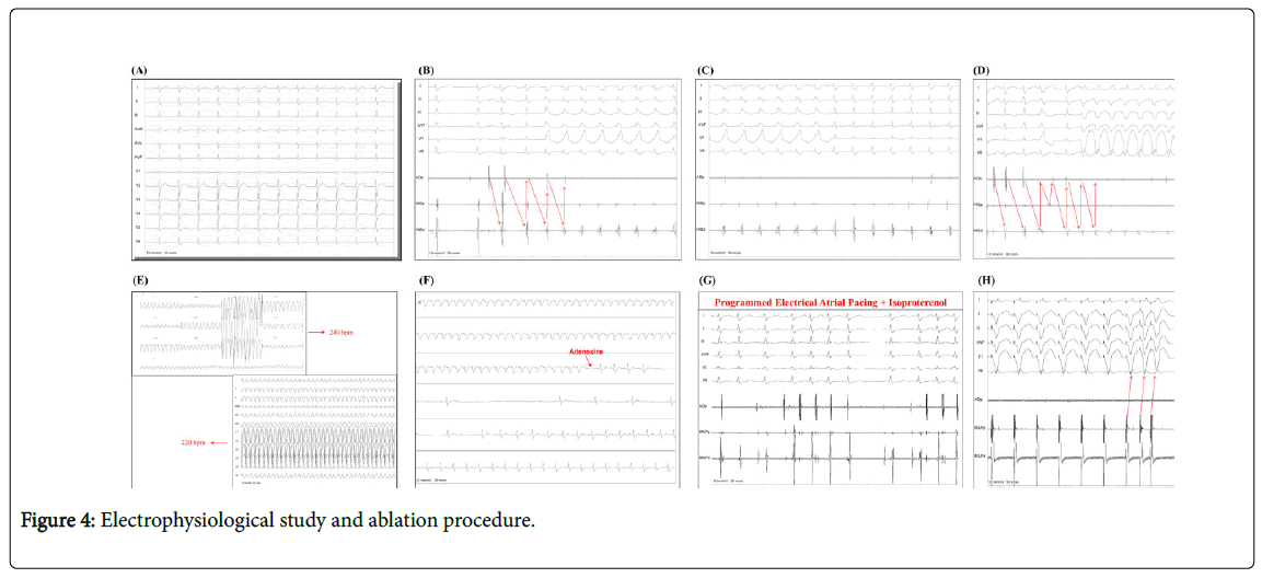 arrhythmia-ablation-procedure