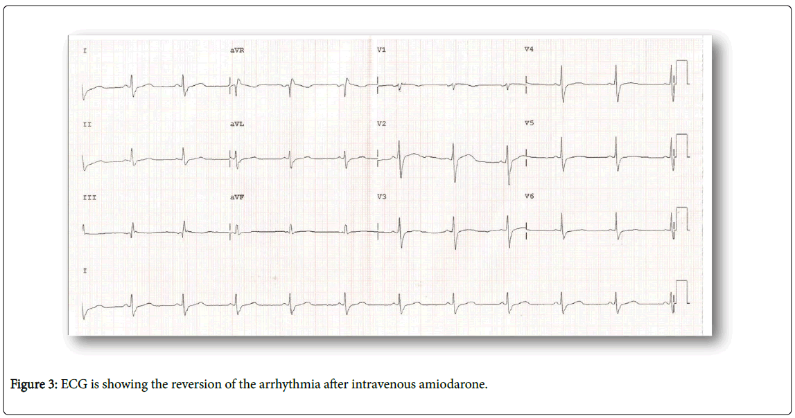 arrhythmia-intravenous-amiodarone