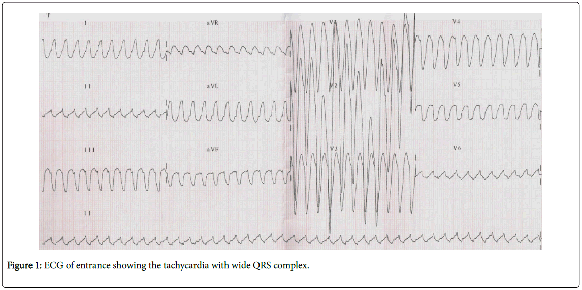 arrhythmia-tachycardia-with-wide-qrs