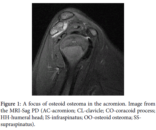 Arthritis-osteoid-osteoma