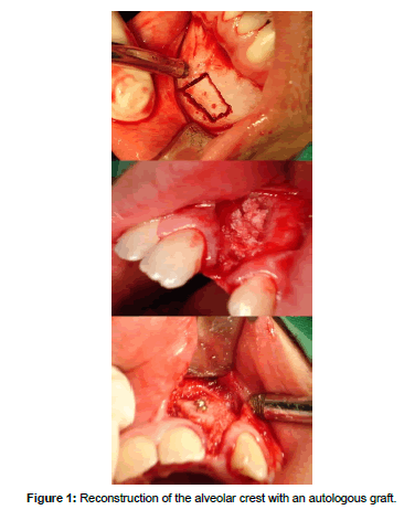 biomimetics-biomaterials-tissue-engineering-Reconstruction