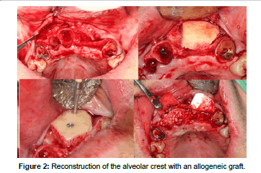 biomimetics-biomaterials-tissue-engineering-alveolar-crest