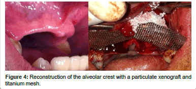 biomimetics-biomaterials-tissue-engineering-particulate