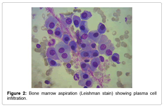 blood-lymph-bone-marrow-aspiration