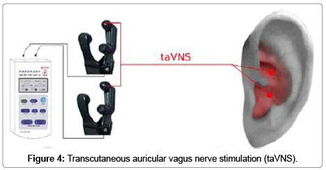 Brain-disorders-therapy-auricular-vagus