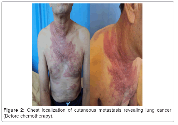 Skin Cancer Metastasis