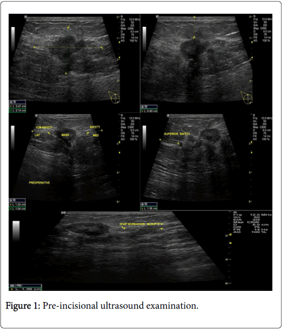 cancer-surgery-Pre-incisional