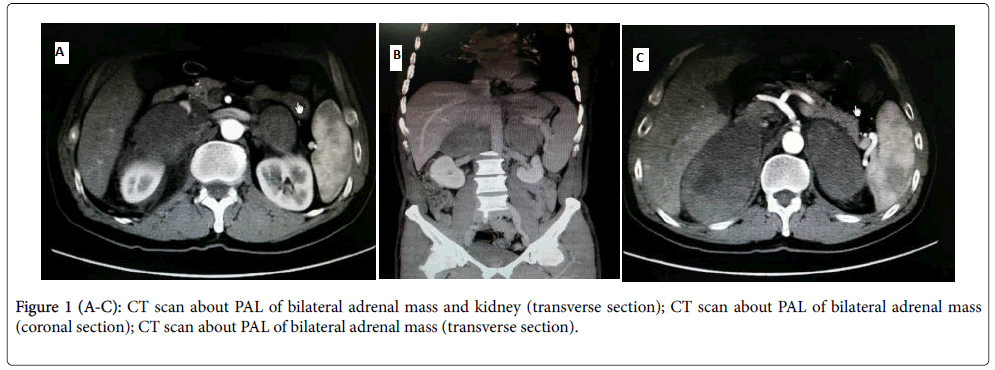 mass on kidney and adrenal gland
