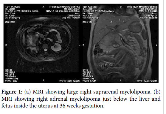 child-health-right-suprarenal