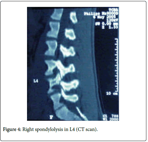 clinical-dermatology-Right-spondylolysis