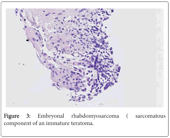 clinical-diagnosis-research-Embryonal-rhabdomyosarcoma