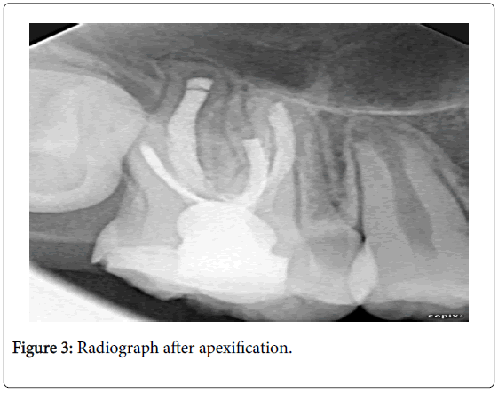 clinical-diagnosis-research-apexification