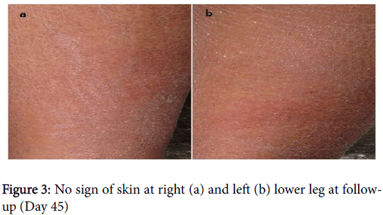 clinical-experimental-dermatology-No-sign-skin