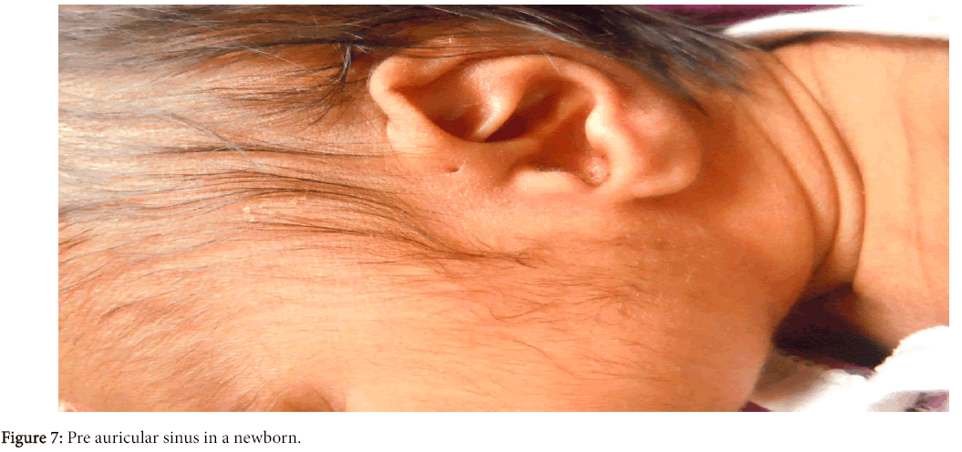 clinical-experimental-dermatology-Pre-auricular-sinus-newborn