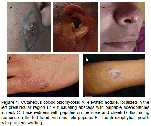 clinical-experimental-dermatology-elevated-nodule