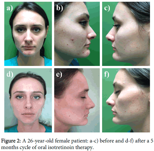 is accutane effective over 50 years old